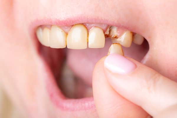 How Dental Fillings Can Fix A Broken Tooth